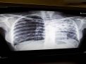 Kajian Dampak Pandemi COVID 19 terhadap Pengendalian Tuberkulosis