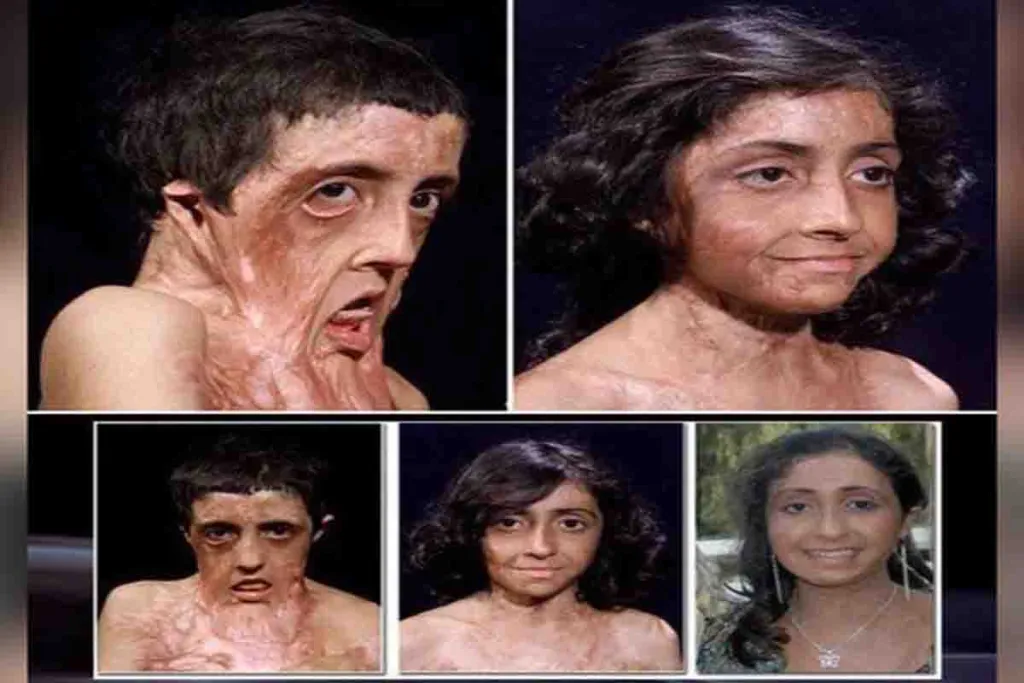 Zubaida Hasan Melawan Luka Bakar dan Diselamatkan Ahli Bedah dari Sherman Oaks