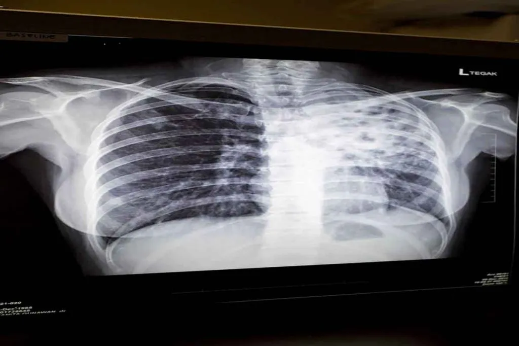 Kajian Dampak Pandemi COVID 19 terhadap Pengendalian Tuberkulosis