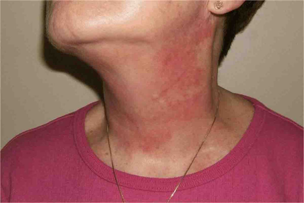 Dampak semprot parfum di leher