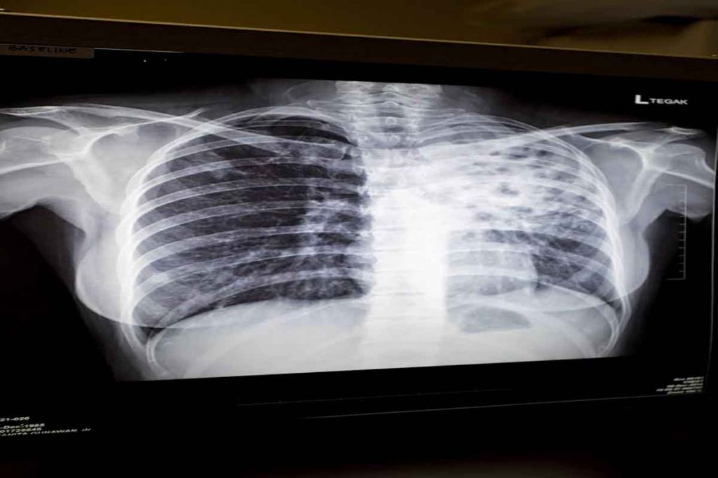 Foto X Ray paru-paru