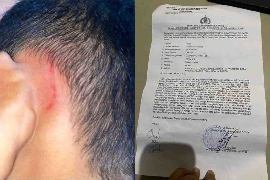 Luka yang dialami anak Heri. Laporan Heri ke Polres Gowa